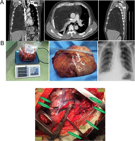 (A) Preoperative chest CT and (B) gross specimen and postoperative chest X-ray. Central Picture: “⊣ shape” incision and intraoperative surgical field after removing the giant mass.