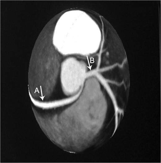 Axial CTA demonstrates an anomalous origin of RCA (Arrow A) which arises as a branch from LMCA (Arrow B).