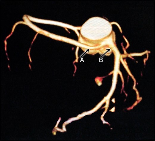 Constructional CT demonstrates an anomalous origin of RCA (Arrow A) which arises as a branch from LMCA (Arrow B).