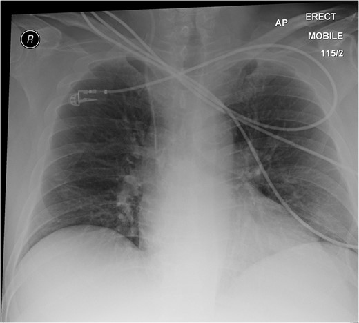 Normal erect chest X-ray. No air under the diaphragm.