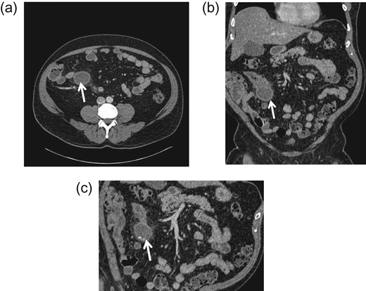 CT abdomen and pelvis (a) transverse; (b) frontal (coronal); and (c) sagittal view. An arrow indicates a blind ending sac at mid-ileal loop.