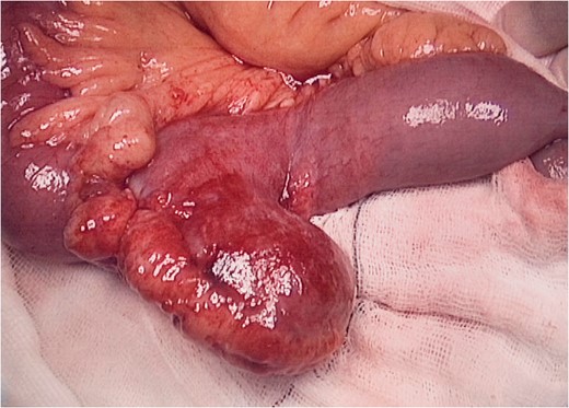 Intraoperative findings: broad based Meckel's diverticulum with oedematous adjacent small bowel (ileum).