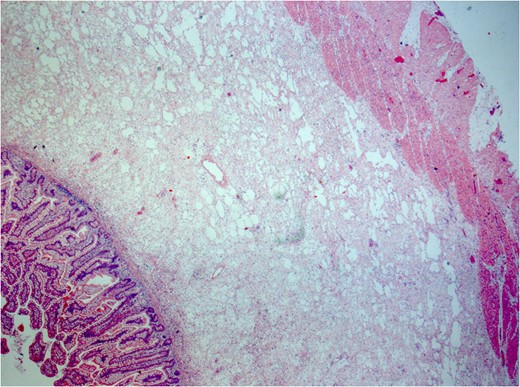 Histology: small bowel histology showing margin of resection with prominent submucosa oedema and mild inflammation.