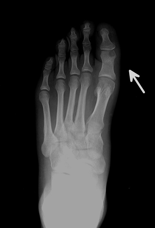 Posterior–anterior X-ray imaging of the left forefoot, showing an intra-articular osteolytic lesion (arrow) in the condyle of the proximal phalanx of the hallux.