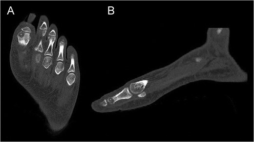 Preoperative CT of the proximal phalanx of the left hallux: axial (A), and sagittal view (B), showing the osteolytic nidus of the tumor with central calcification surrounded by a slight sclerotic halo: the standard image of OO.