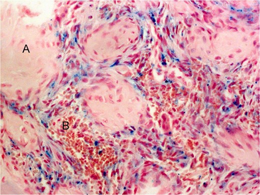 Histological image of the lesion. (A) Woven bone. (B) Blood vessels (original magnification ×40, Perls tintion).
