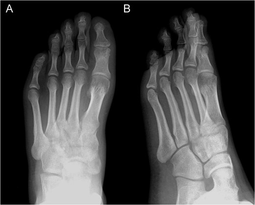 Posterior–anterior (A) and oblique (B) X-ray imaging of the left forefoot, showing the integration of the bone graft after 6 weeks.