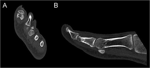 CT of the proximal phalanx of the left hallux: axial (A) and sagittal view (B), showing the recurrence of the OO and its extension to the articular surface.