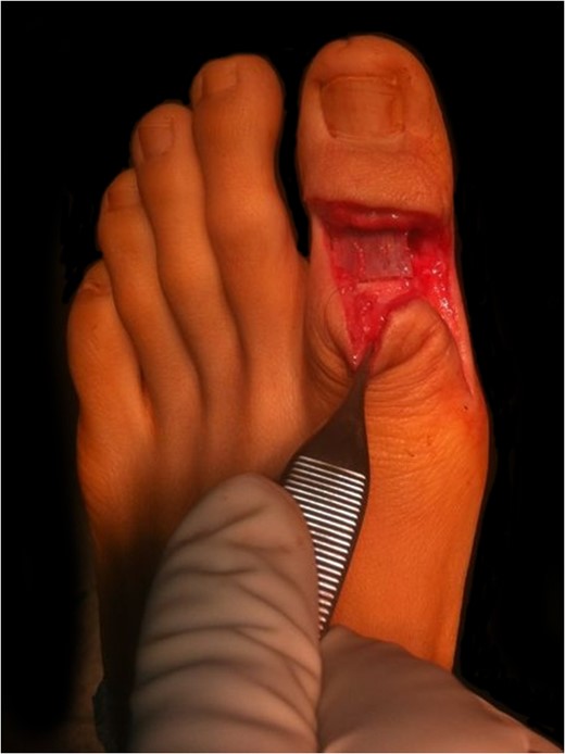 Intraoperative image of the hallux showing the interposition of a tricortical autograft preserving the length of the big toe.
