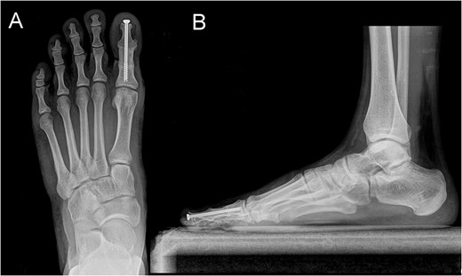 Posterior–anterior (A) and lateral (B) X-ray imaging of the left foot, showing the arthrodesis without signs of recurrence after a follow-up of 30 months.