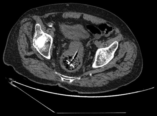CT showing migrated PEC tube (axial plane).