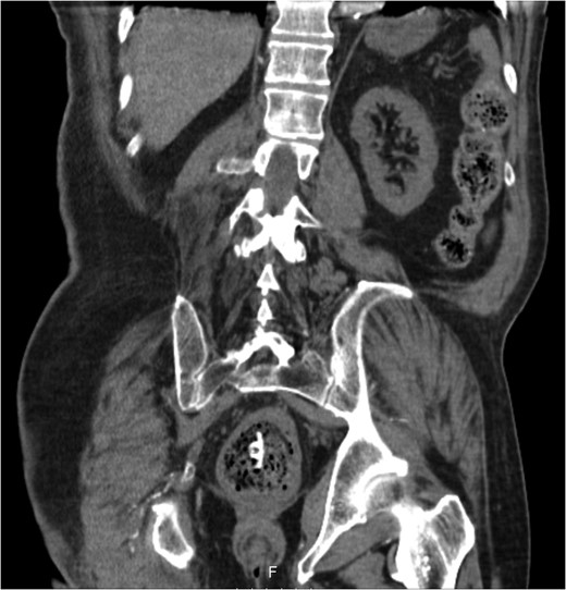 CT showing migrated PEC tube (coronal plane).