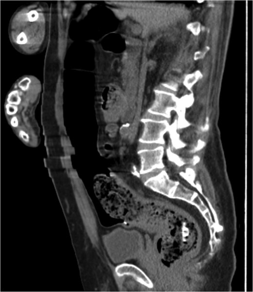 CT showing migrated PEC tube (sagittal plane).
