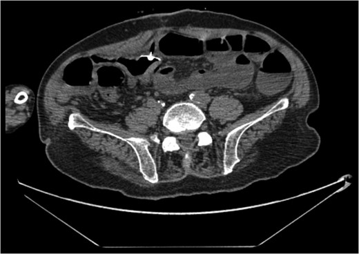 CT showing re-sited PEC tube (1).
