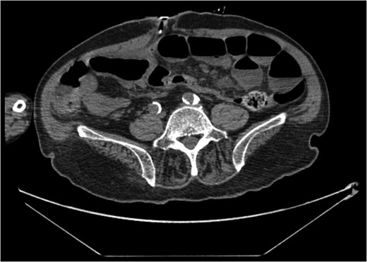 CT showing re-sited PEC tube (2).