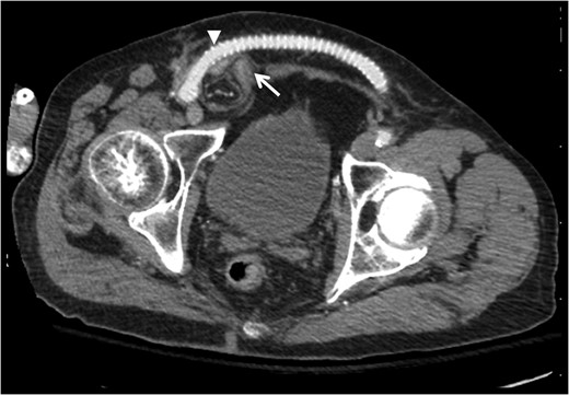 Contrast-enhanced computed tomography axial image demonstrating relationship of bowel-containing inguinal hernia (arrow) with femorofemoral PTFE graft compressing the area of the internal ring (arrowhead).