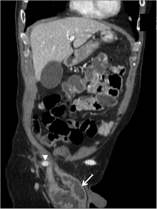 Contrast-enhanced computed tomography coronal image demonstrating the right femorofemoral anastomosis and graft (arrowhead) overlying the hernia sac at the internal ring, with dilated loops of bowel in the hernia sac within the scrotum (arrow).