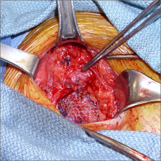 Intraoperative images demonstrating the ringed PTFE graft (tip of forceps) and the tension-free mesh herniorraphy. The external oblique aponeurosis was subsequently closed to provide a layer of separation between mesh and graft.