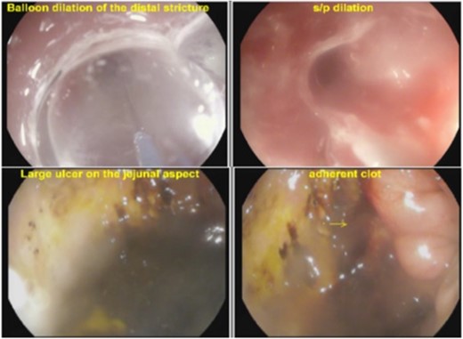 Endoscopic images of cologastric stricture before and after balloon dilation. Ulcerative disease is seen at the jejunal aspect of the patient's gastrojejunostomy.