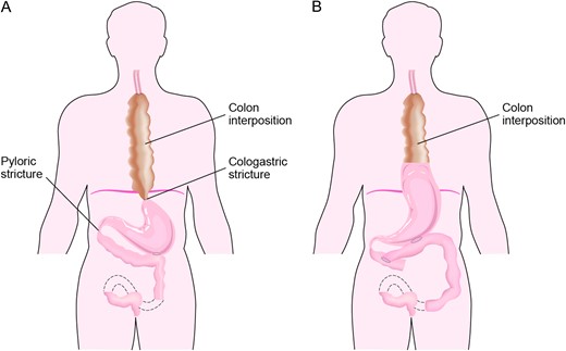 Preoperative cologastric and pyloric strictures (A) and post-operative changes including new cologastric, gastrojejunal, duodenojejunal anastomoses (B).