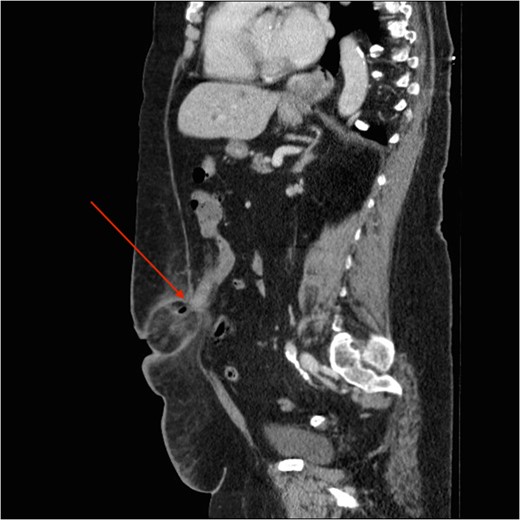 Sagittal slice of the CT demonstrating the paraumbilical sac containing cecum and appendix along with fat stranding and air loculation and narrow neck (red arrow).