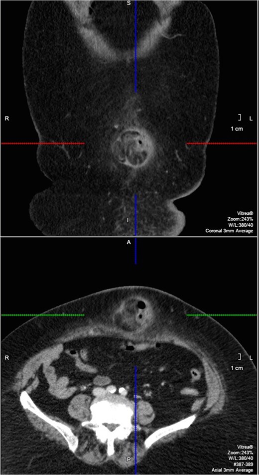 Coronal and axial slice of the CT showing the paraumbilical hernia (within marked areas).