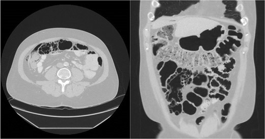CT abdomen pelvis with IV contrast demonstrating cystic pneumatosis coli.