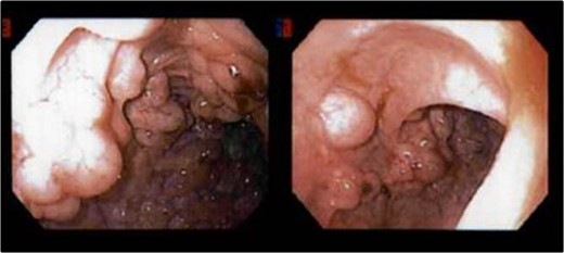 Flexible sigmoidoscopy: sigmoid colon.