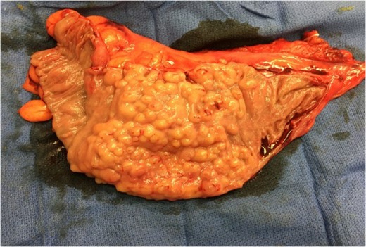 Surgical specimen: sigmoid colon, opened.