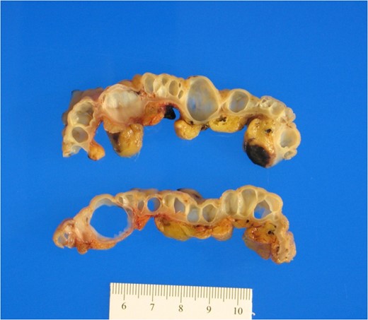Multiple submucosal air pockets (cysts) ranging in size from 0.3 to 1.5 cm.