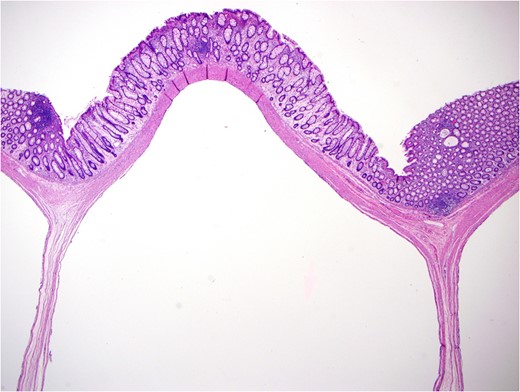 Microphotograph: multiple cystic spaces in submucosa and muscularis propria, with mild hyperplastic mucosal changes. H&E stain, original magnification Ă—40.