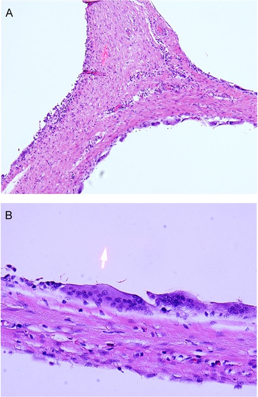 Microphotographs: cystic spaces are lined by histiocytes and multinucleated giant cells. H&E stain, original magnification ×200 (A) and ×400 (B).