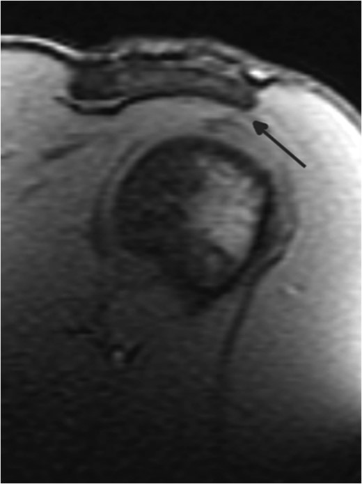 MRI shoulder.