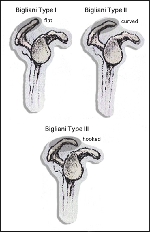 Acromial morphology.