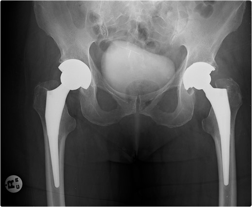 X-ray pelvis—showing bilateral well-fixed THRs.