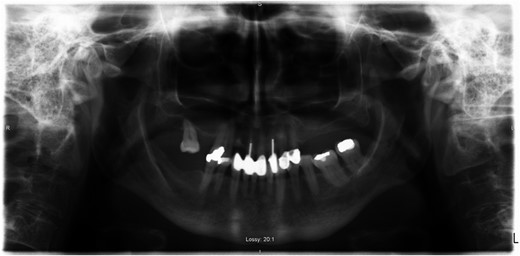 Orthopantomogram—showing dental implants and fillings.