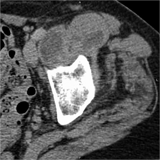 Computed tomography scan showing left iliopsoas involvement and heterogeneity, with a well-defined intramuscular hypoattenuation typical for abscess formation.