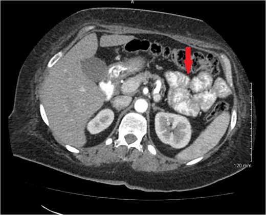 CT scan of abdomen showing ascending colon mass.