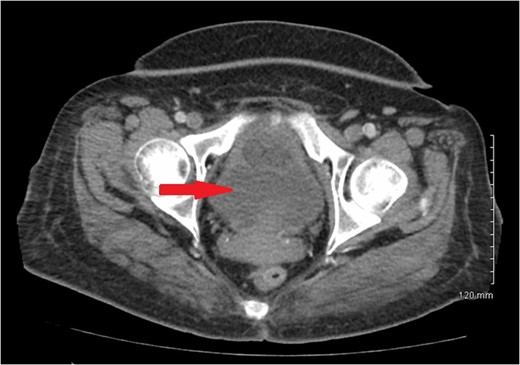 CT scan of pelvis showing uterine hypodense mass.