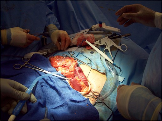 Exteriorization of the ascending colon mass.