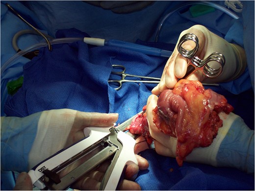 Extracorporeal ileotransverse colic anastomosis.