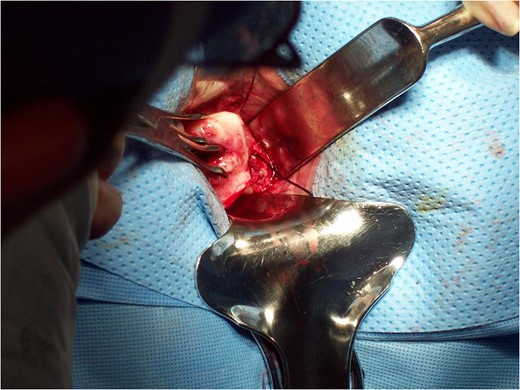 Dissection of uterosacral ligament vaginally.