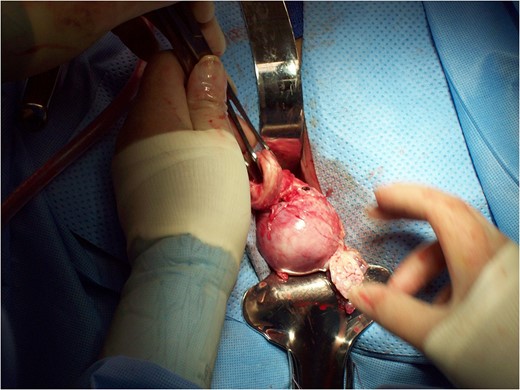 Completion of vaginal hysterectomy.