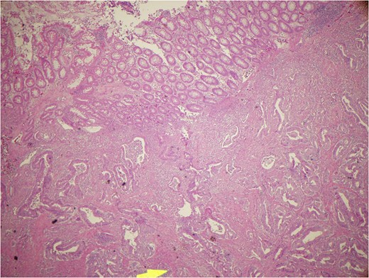 Mucous producing adenocarcinoma.