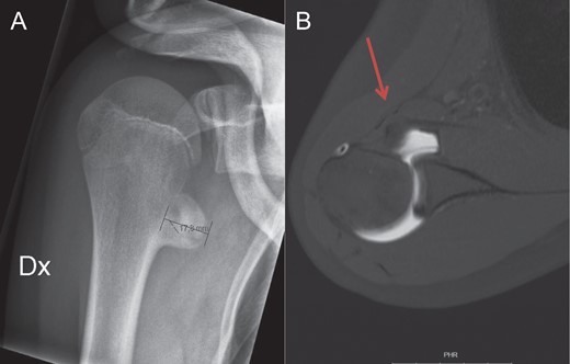 Anteroposterior view of the right shoulder (A) shows the exostosis localized inferior and medial to the origin of the native lesser tuberosity. On the transverse view of the arthro MRI (B), the anteriorly displaced subscapularis tendon due to the new insertion site on the exostosis, is marked with the red arrow.