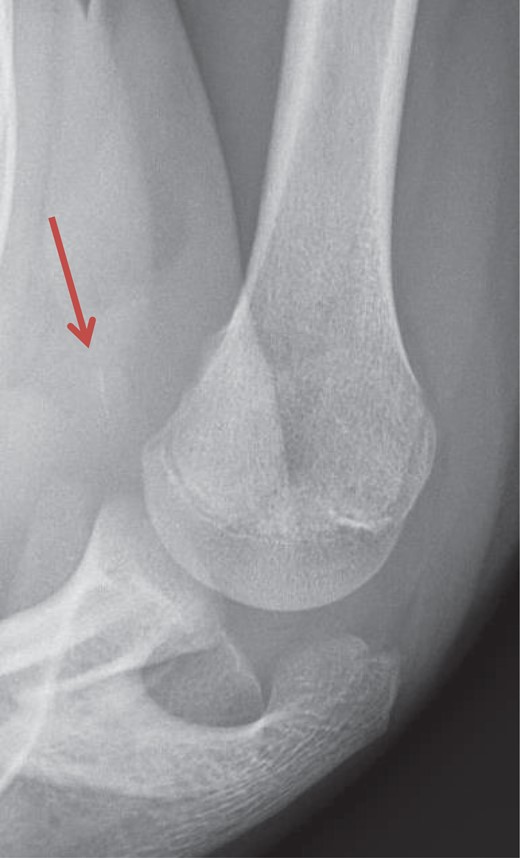 Axillary lateral view of the injured right shoulder. The avulsion fragment of the lesser tuberosity is marked by the red arrow.