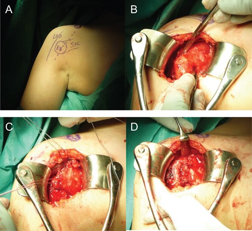 Open repair of the subscapularis tendon with a suture bridging technic leaving the uninjured long head of the biceps intact. The standard deltopectoral incision goes directly over the palpable bony mass developed after endostal hematoma ossification (A). Almost the complete subscapularis tendon was attached to the bony mass (B). After osteotomizing the tendon insertion, the tendon including the underlying anterior capsule, was dissected free (C) and secured back to anatomic position using suture bridging technic (D).