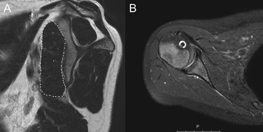 MRI 1-year after surgery. In the sagittal view there are no sign of atrophy or fatty infiltration of the subscapularis muscle (A). The subscapularis tendon is healed in an anatomical position (B).