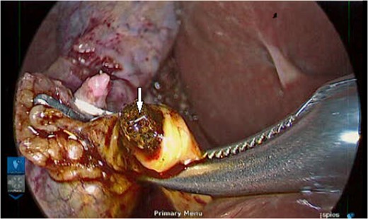 A live helminth is seen on the stone during extraction.