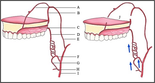 Blood supply of the maxilla. (A) Nasopalatine artery, (B) Descending palatine artery, (C) Greater palatine artery, (D) Lesser palatine artery, (E) Maxillary artery, (F) Ascending pharyngeal artery, (G) Ascending palatine artery, (H) Facial artery, (I) External carotid artery, (J) Le Fort I downfracture.